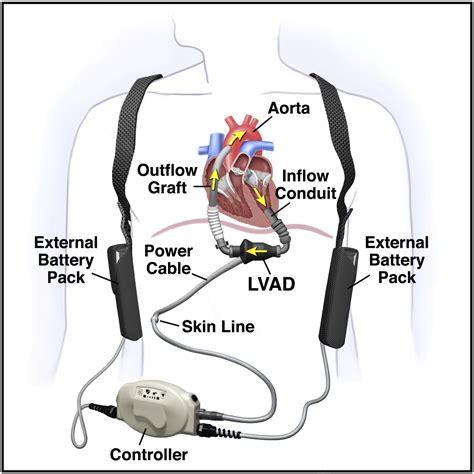 Left Ventricular Assist Devices Physiologic Assessment Using