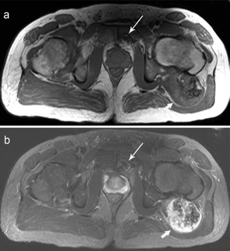 A Axial T1 Weighted Spin Echo And B Axial T2 Weighted Tse Fat