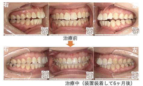 マウスピース矯正（インビザライン）の治療経過｜福岡市中央区の薬院大通駅近くの矯正歯科