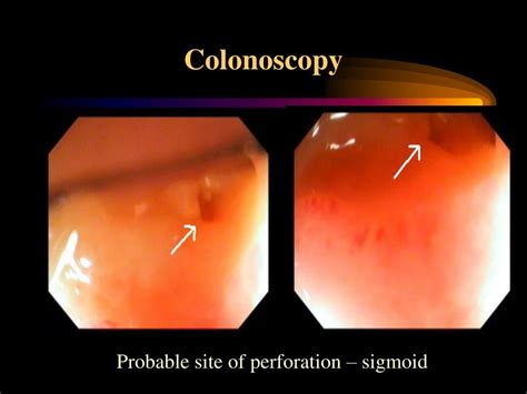 Ppt An Unusual Presentation Of Severe Ulcerative Proctocolitis Powerpoint Presentation Id