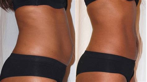 Strawberry Inch Loss Non Surgical Laser Lipo Fat Reduction