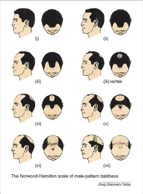 Male Pattern Baldness Scale