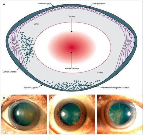 Cataracts Types