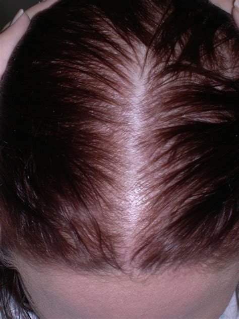 Normal Hair Part Width