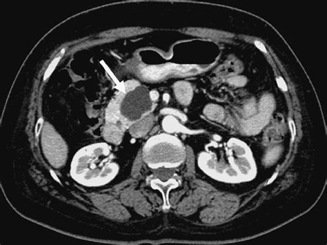 Macrocystic Pancreatic Lesions Differentiation Of Benign From