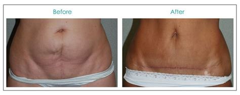 Before And After Plastic Surgery Photos Beautiful Patient Results Tummy Tucks Mini Tummy Tuck