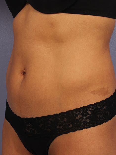 Los Angeles CoolSculpting Before And After Photos Beverly Hills