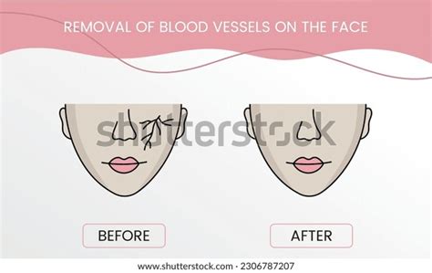 Face Blood Vessel Before After Stock Photos - 4 Images | Shutterstock