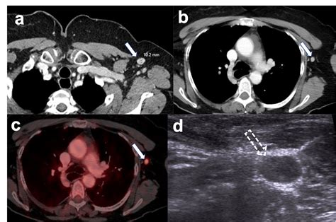 Axillary and Neck Adenopathy in the Era of Mass COVID-19 Vaccination | The Scan