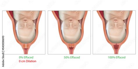 Cervical Effacement And Dilation During Delivery Cervix Labor Or