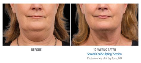 CoolSculpting Los Angeles Beverly Hills Body Contouring Chin Fat