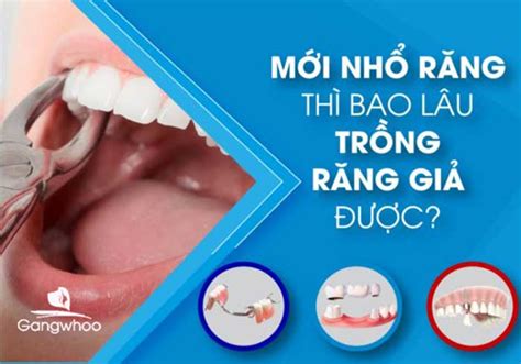 Nhổ Răng Cửa Bao Lâu Thì Trồng Lại Được Bác Sĩ Giải Đáp