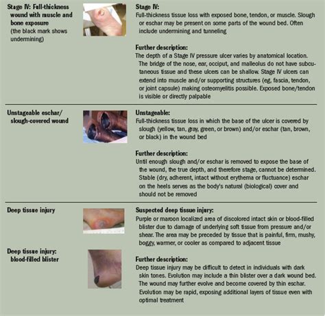 Heel Pressure Ulcer Stages Images, Photos | Mungfali