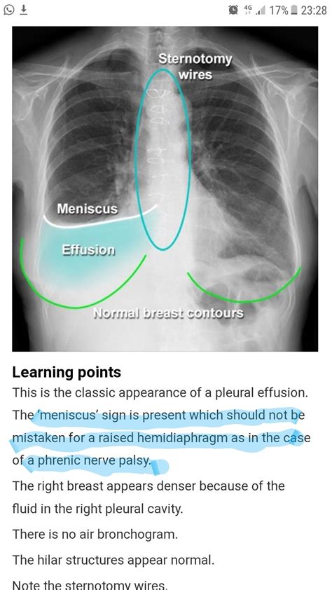 Meniscus Sign Pleural Effusion