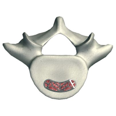 Posterior Spine Truss System Web Medical