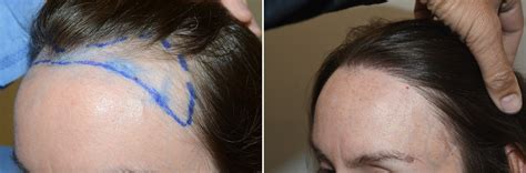 Hair Transplants For Women Photos Miami Fl Patient126894