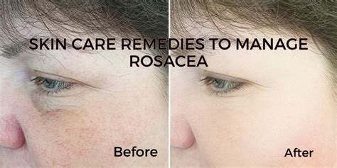 Skin Care Remedies To Effectively Manage Rosacea