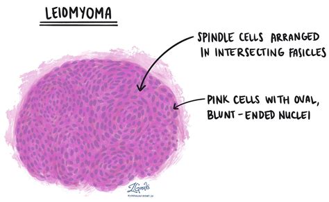 Leiomyom Mypathologyreport Ca