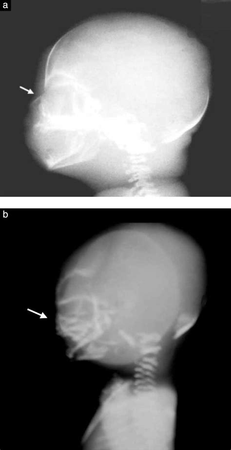 Nasal Bone Ultrasound Weeks