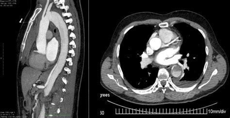 Acute type B aortic dissection – Vascupedia