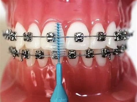 Learn How to Brush Your Teeth With Braces | Salaita Orthodontics