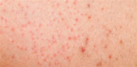 Folliculitis Treatments Mesa AZ Sagebrush Dermatology