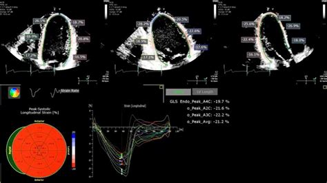 A Practical Guide To Echocardiographic Global Longitudinal Strain GLS