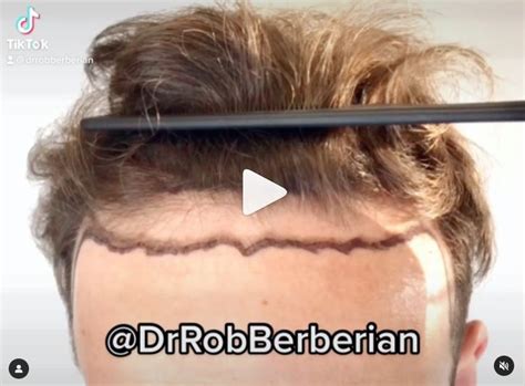 Can You Get A Hair Transplant Without Shaving Your Hair Dr Rob