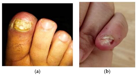 Staph Infection Fingernail