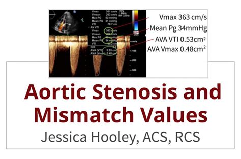 Aortic Stenosis And Mismatch Values Cardioserv