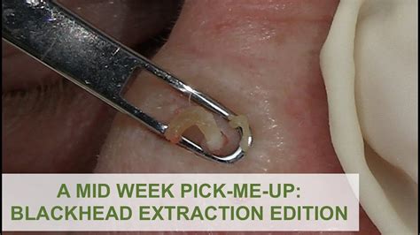 A Mid Week Pick Me Up Blackhead Extraction Edition Dr Derm YouTube