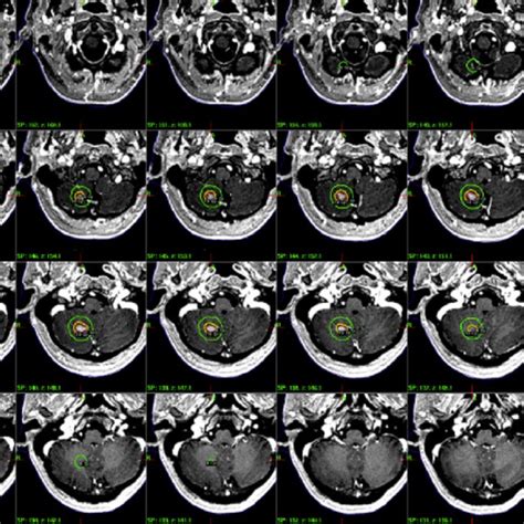 Gamma knife radiosurgery treatment plan. | Download Scientific Diagram