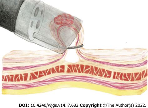 The Cap Assisted Endoscopic Mucosal Resection Technique Download