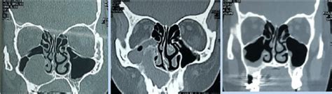 A Ct Of A Right Radicular Maxillary Cyst Not Occupying The Whole