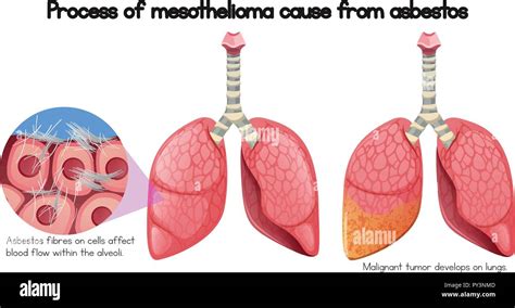 Process Of Mesothelioma Cause Of Asbestos Illustration Stock Vector