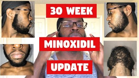 Growing A Beard With Minoxidil A Black Mans Experience Week 30 Steady