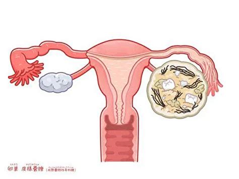 【閲覧注意】人間の体内でこんなものが育つ可能性があるってマジかよ・・・（画像あり） ポッカキット