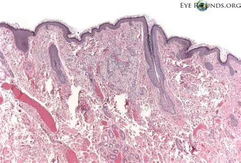 Atlas Entry - Xanthelasma