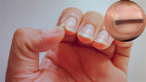 6 Disturbing Things Your Nails Reveal About Your Health By Laura Elin