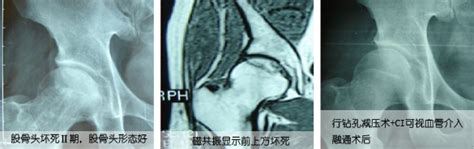 股骨头坏死微创髓芯减压术介入融通术