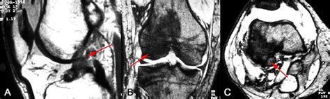 Tumores De Rodilla