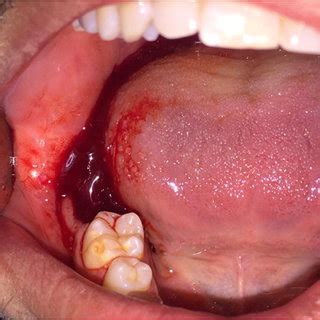 Mandibular Molar Extraction