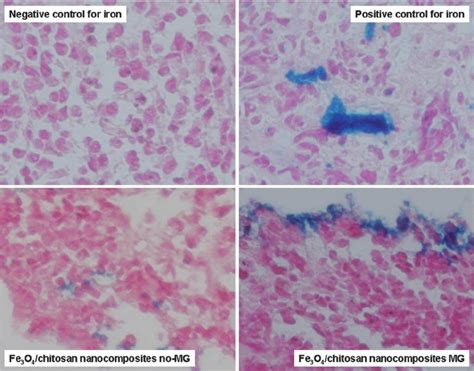 Prussian Blue Stain Bone Marrow