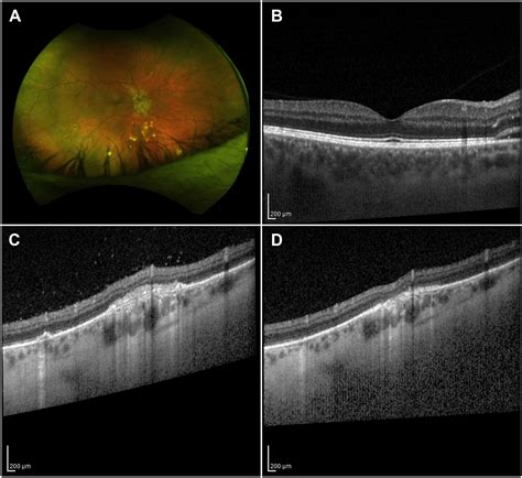 Localized Peripheral Vitritis On Oct In Multifocal Choroiditis And