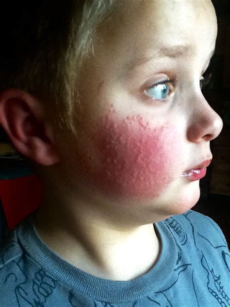 What Causes Hives And How Dangerous Can They Be? A Nurse, 48% OFF