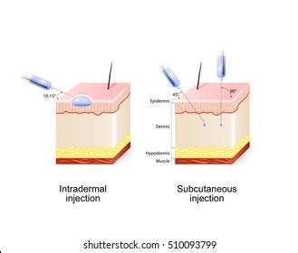 Intradermal Subcutaneous Injection Angle Depth Injections Stock Vector ...