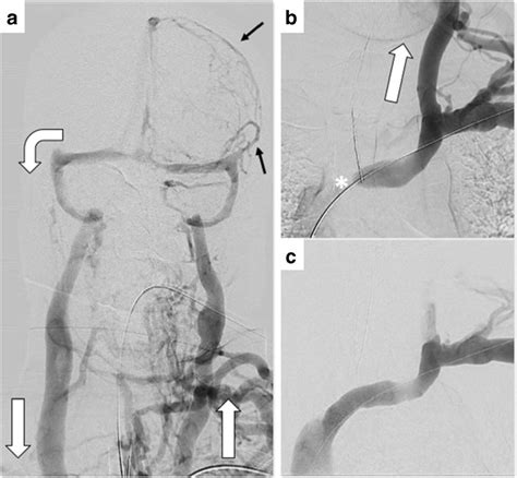 A Cranio Cervical Frontal Angiogram After Injection In The Left Download Scientific Diagram