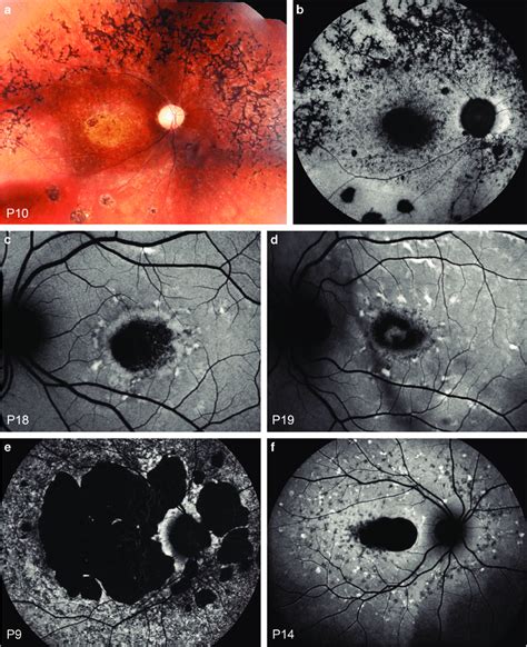 Moderate To Severe Phenotypes Were Associated With The C 859 9t4c Download Scientific Diagram