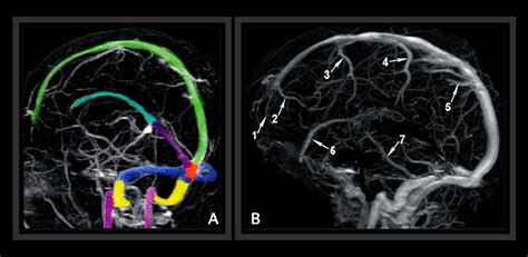 MRI BLOG: Dural Sinus Thrombosis