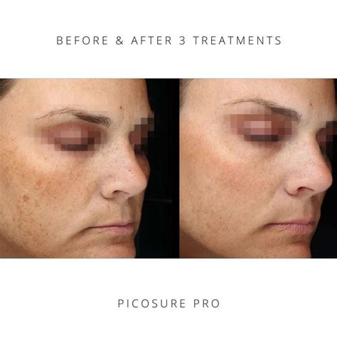 Picosure Pro - The Grand Medical Aesthetic Clinic